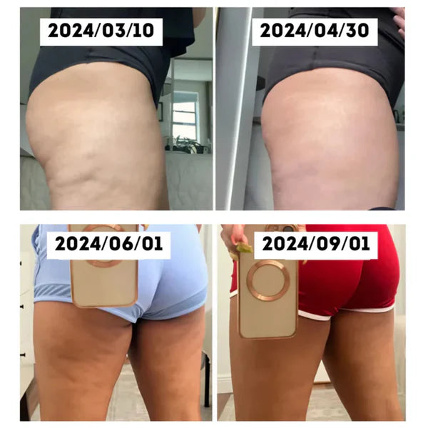 Anti-Cellulitt Massasje – Glattere & Strammere Hud